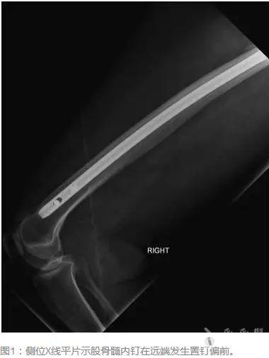 injury:老年患者股骨髓内钉远端总是偏前,到底什么原因?