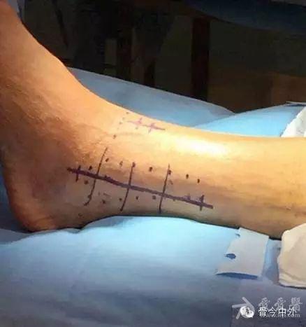 后踝骨折的腓骨截骨入路手术经验总结