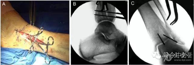 后踝骨折的腓骨截骨入路手术经验总结