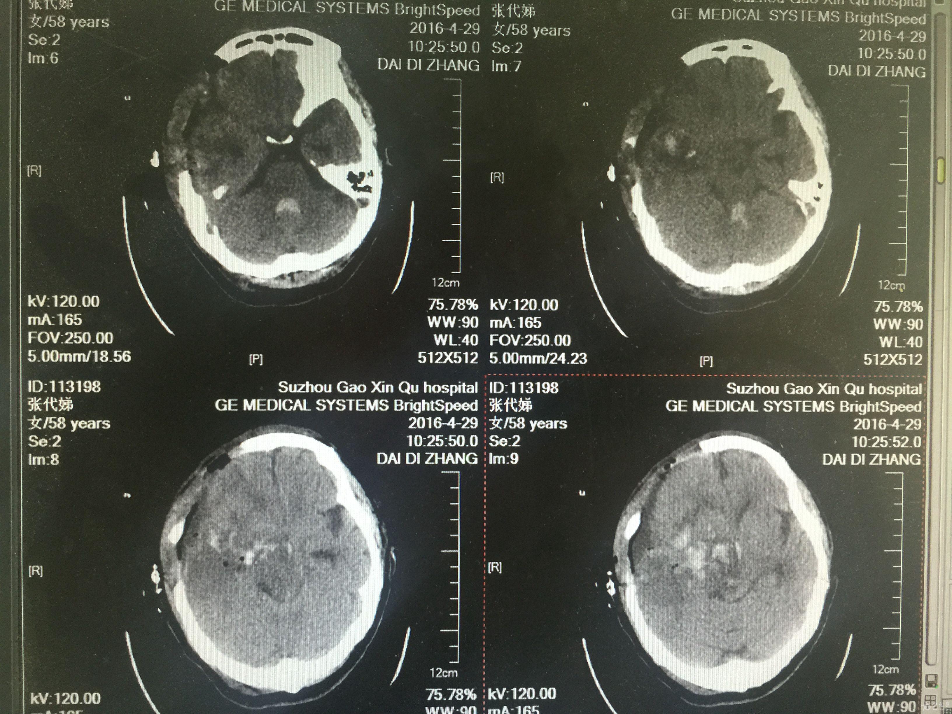 分享一例自发性颞顶叶脑出血伴迟发脑干出血原创