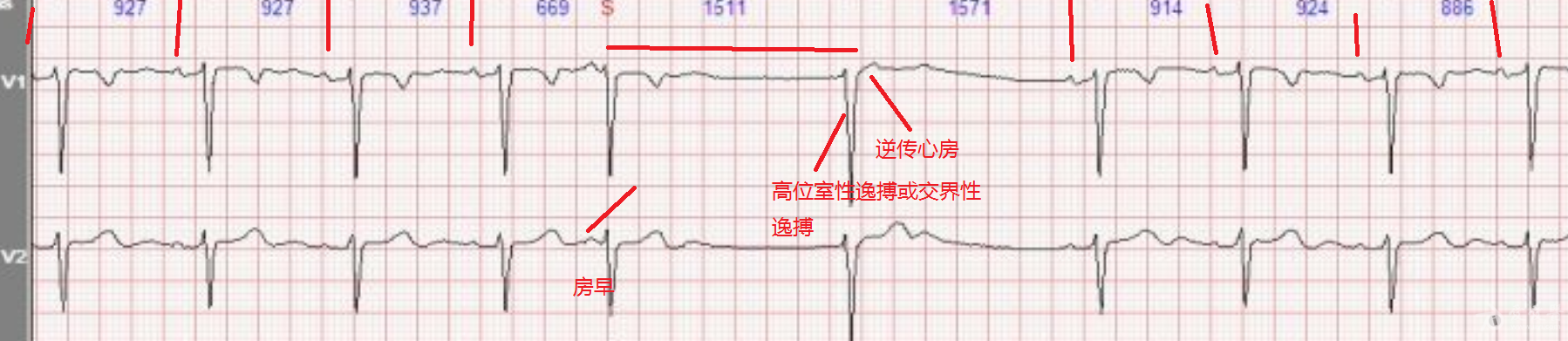 支持超版诊断,房性早搏引起窦房结抑制出现窦性停搏,高位室性逸搏或