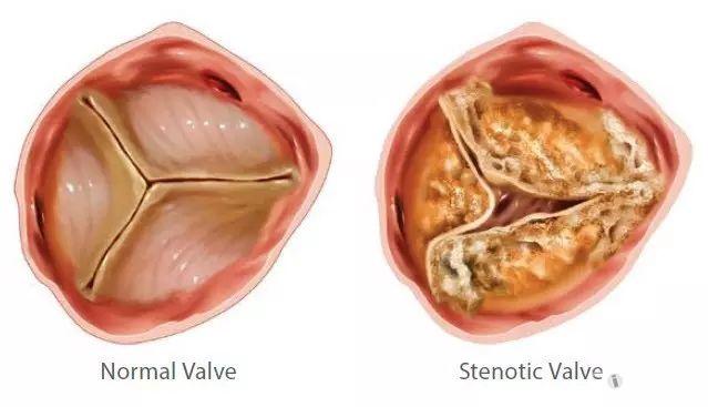 主动脉瓣狭窄怎么办?