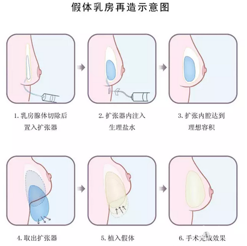 肌肉等软组织缺损较少,有足够覆盖,且对侧乳房不十分大,无明显下垂,不