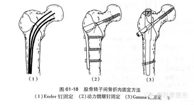 人生最后一次骨折之股骨粗隆间骨折