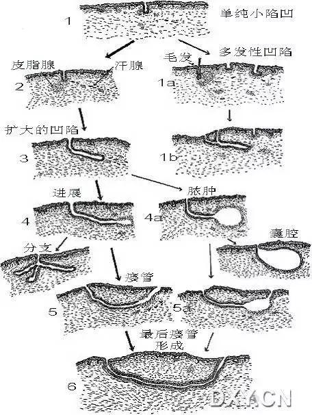 【转帖】手把手教你藏毛窦手术该怎么做