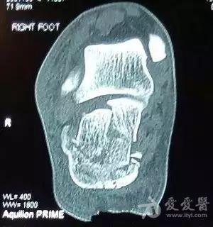 跟骨骨折的微创手术治疗