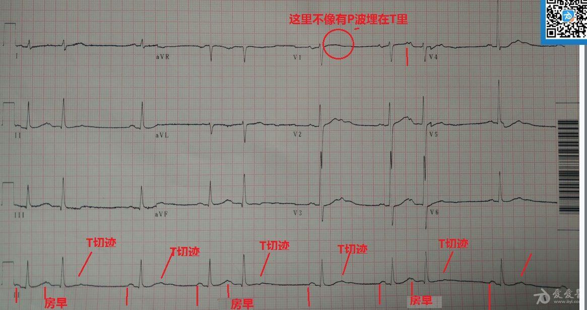 请教老师们,关于t波的图! - 心电图脑电图专业讨论版