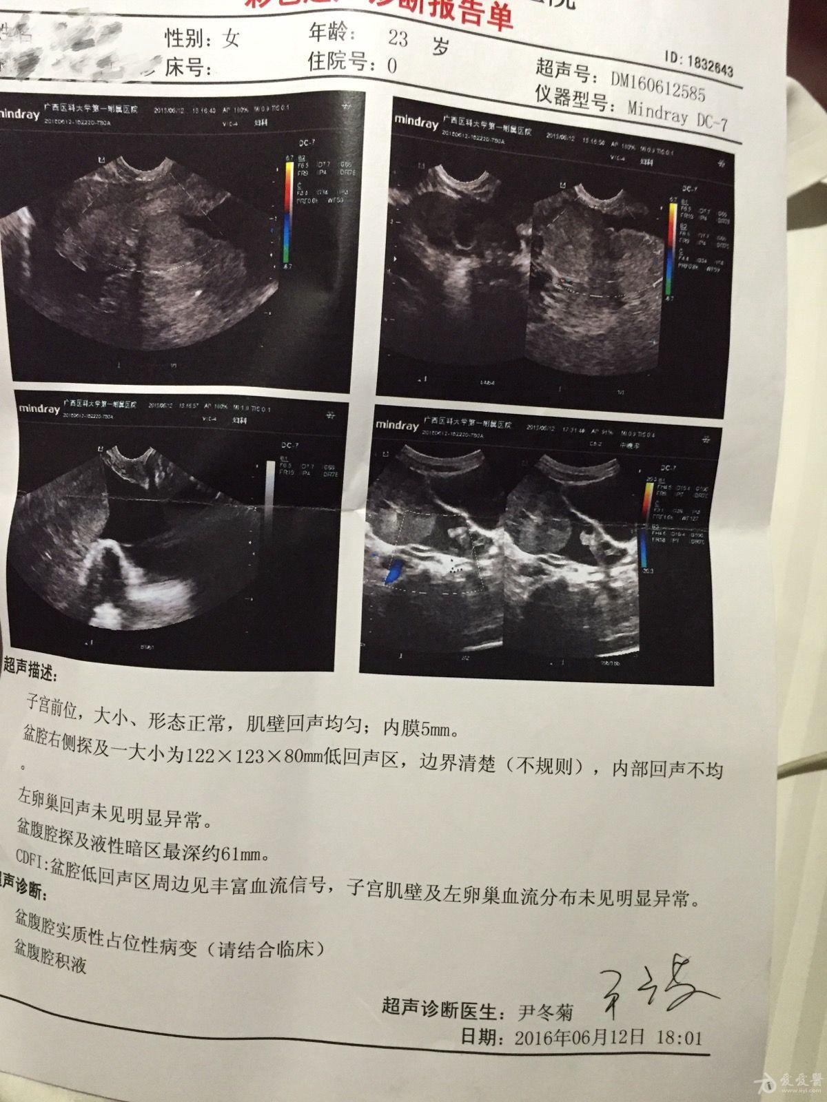 盆腔实性包块会是卵巢ca吗