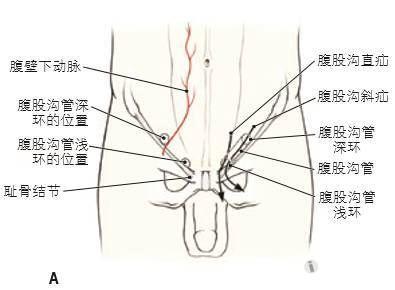 腹股沟疝依据其相 对于腹壁下血管的位置分类.腹股沟斜疝经
