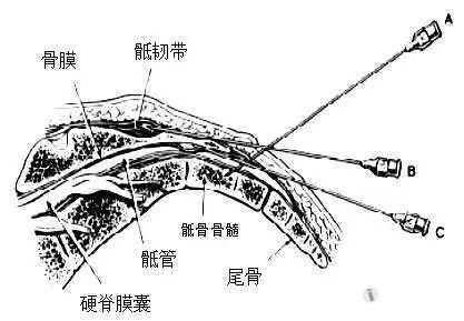 骶管麻醉麻药中毒的原理与救治