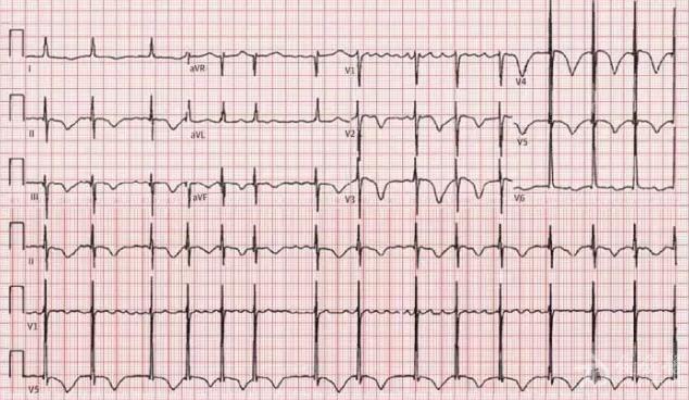 t波倒置知多少? - 心血管内科讨论版 - 爱爱医医学论坛