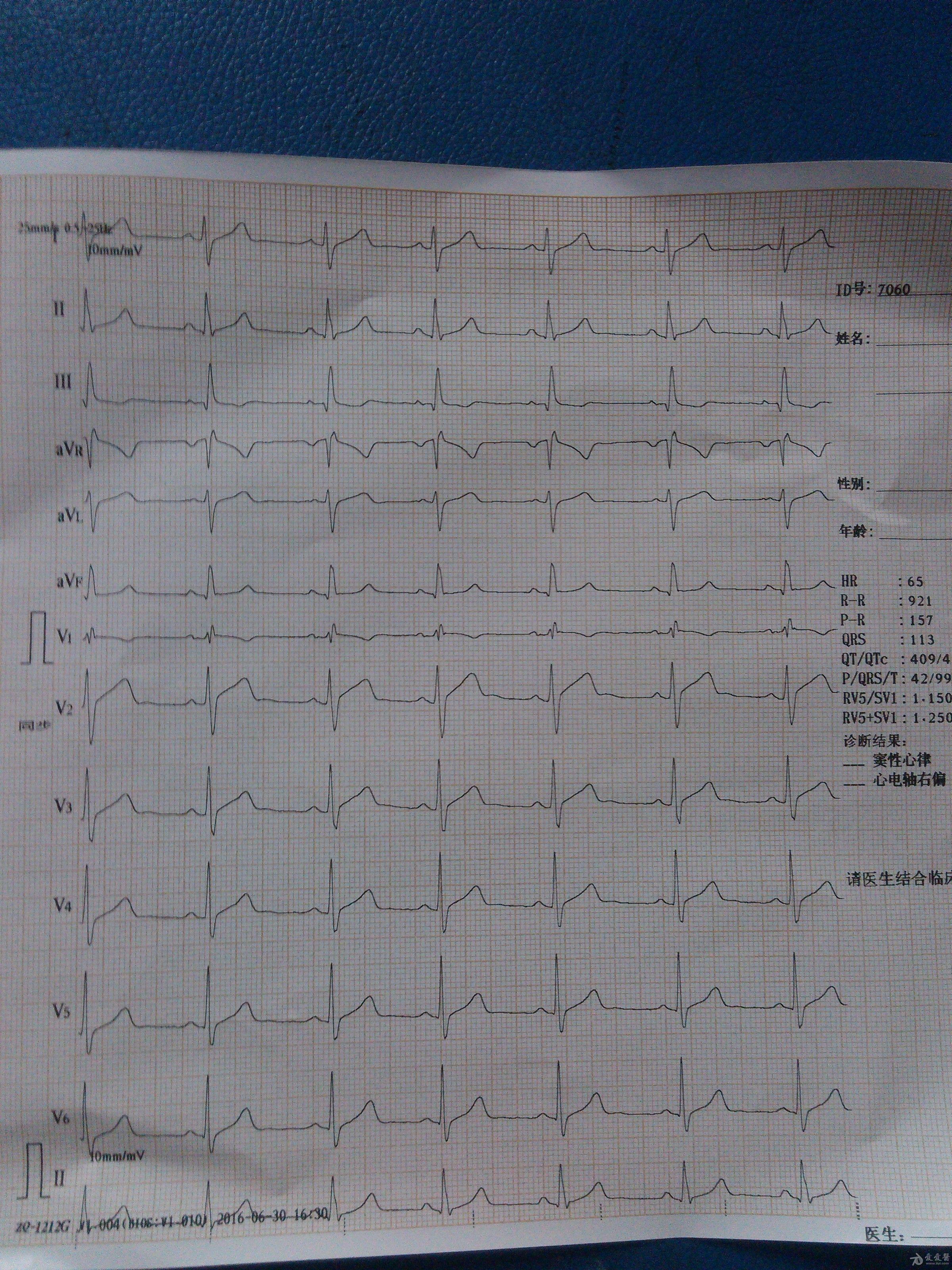 正常范围心电图?不完右?