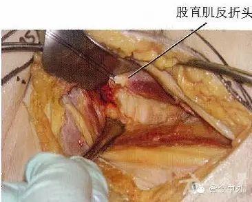 股骨颈骨折切开复位内固定手术要点