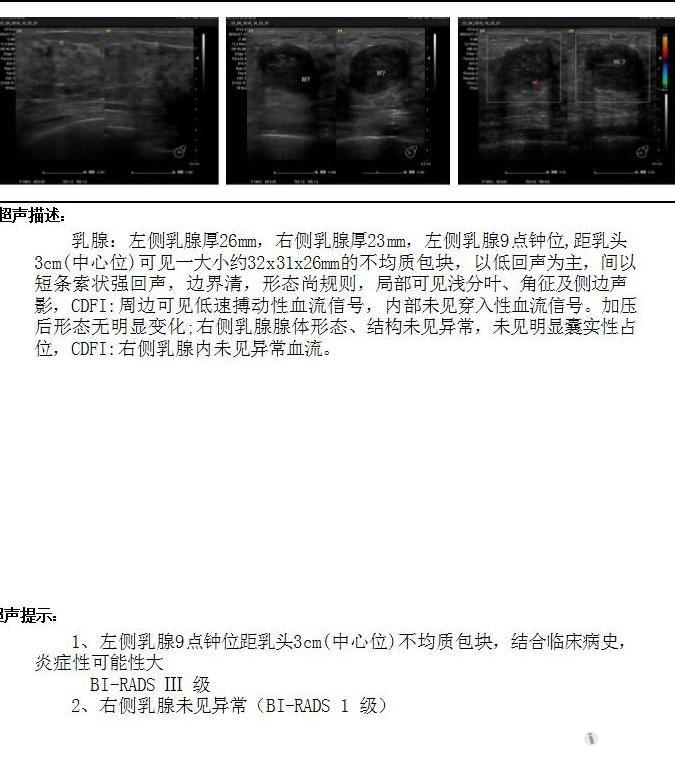 哺乳期乳腺包块,应该如何考虑? - 超声医学讨论版