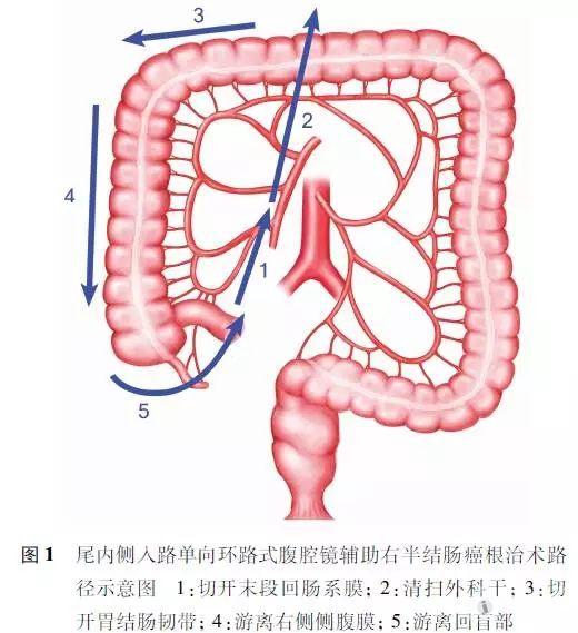 尾内侧入路单向环路式腹腔镜辅助右半结肠癌根治术的临床疗效