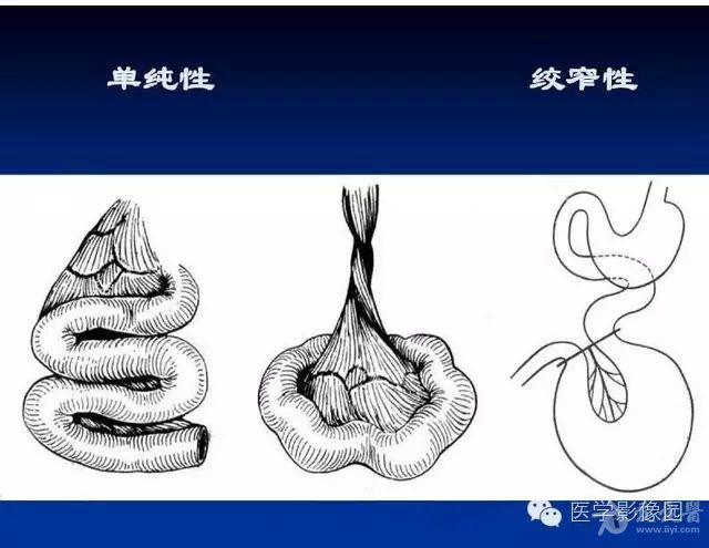 最全肠梗阻的分类及影像学表现要点解读