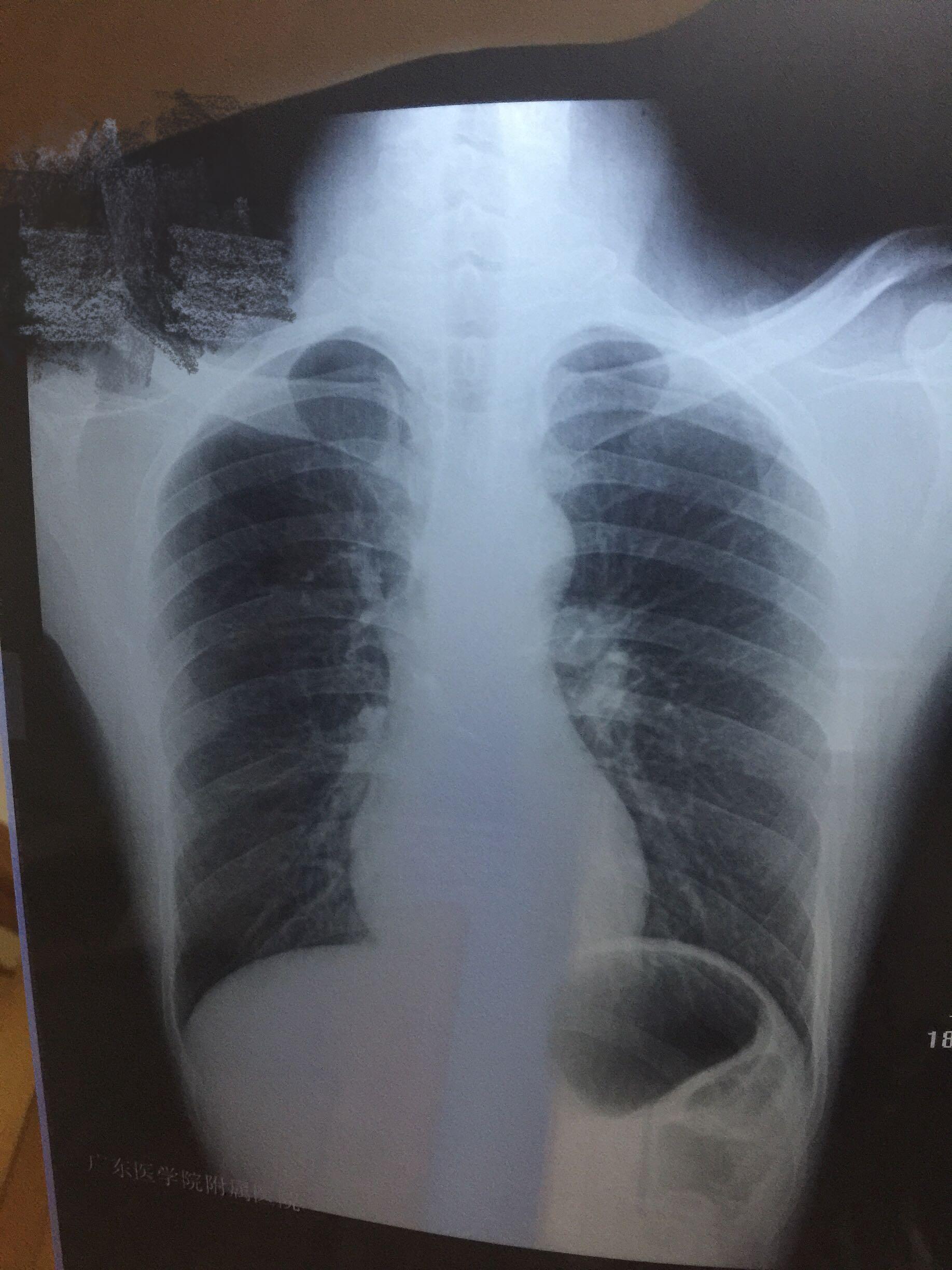 x片结果双肺纹理增粗左侧肺门稍浓