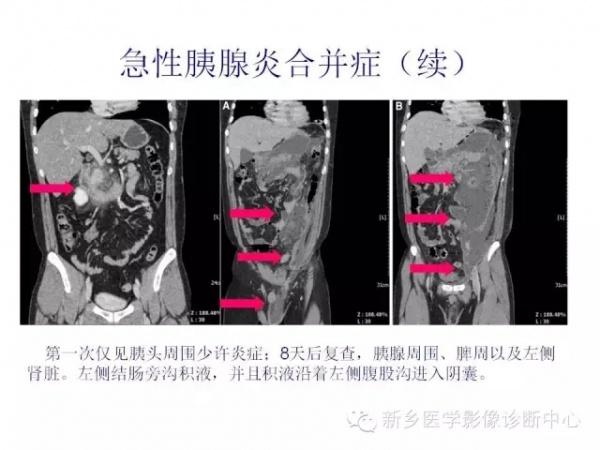 影像学在胰腺炎诊断的应用