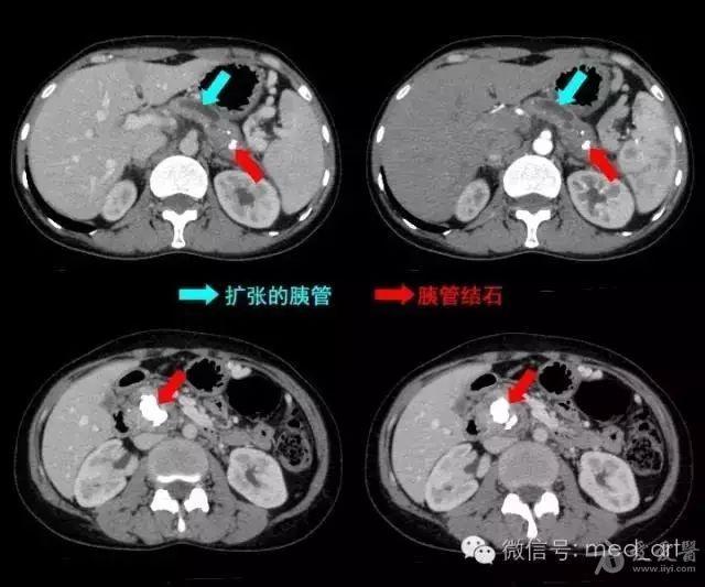 保留中段的胰腺切除术