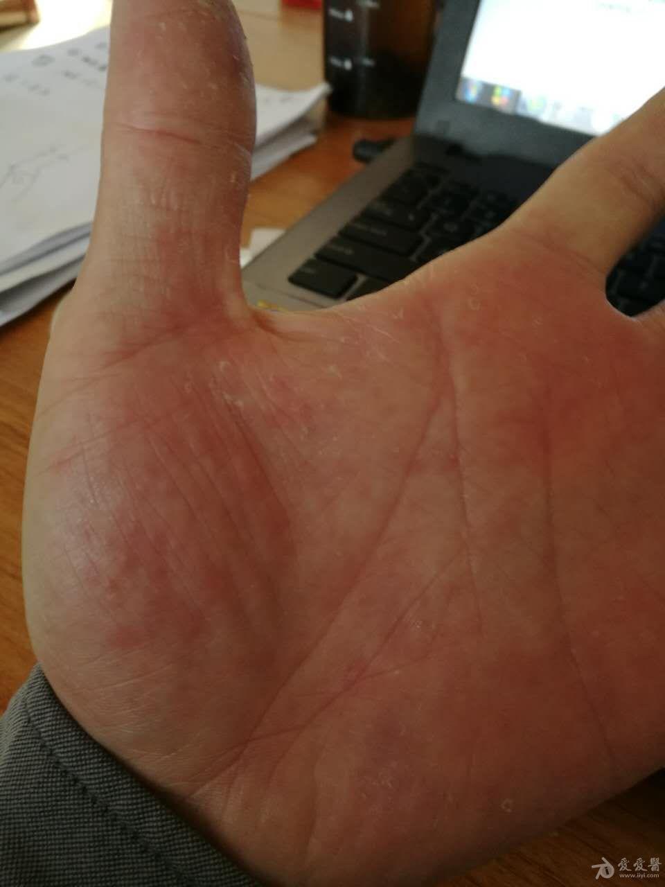 手掌表皮下起红点痒过后表皮会呈圆点脱落