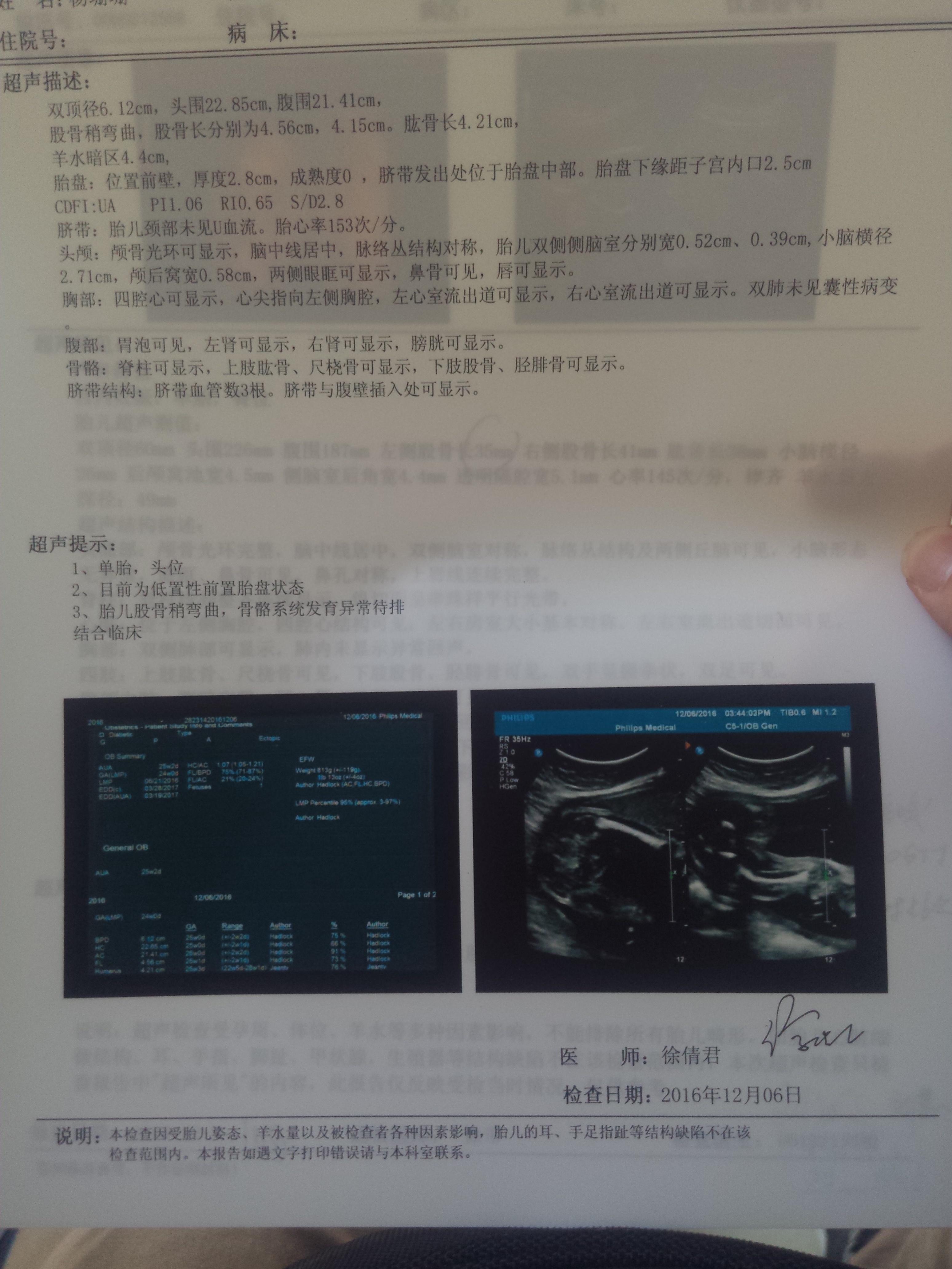 孕24周 做四维彩超 显示一侧股骨弯曲