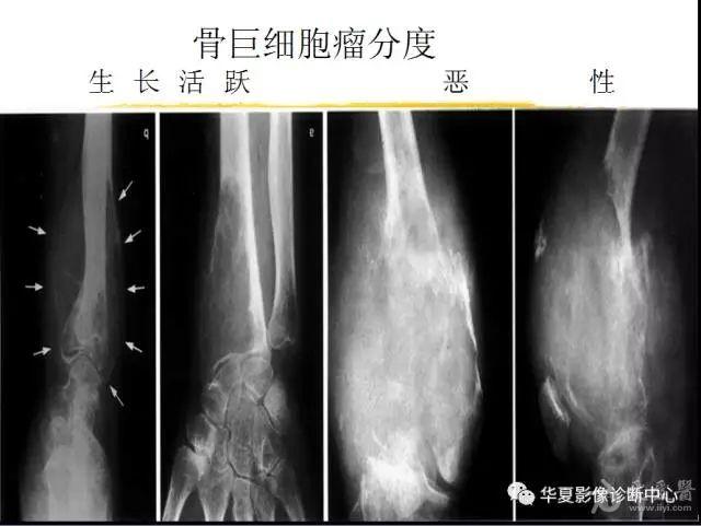 骨巨细胞瘤的影像诊断与签别