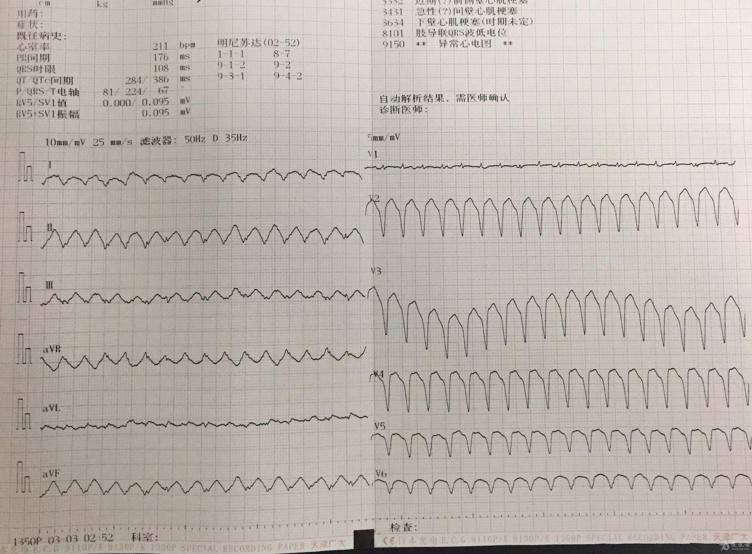 正常12导联