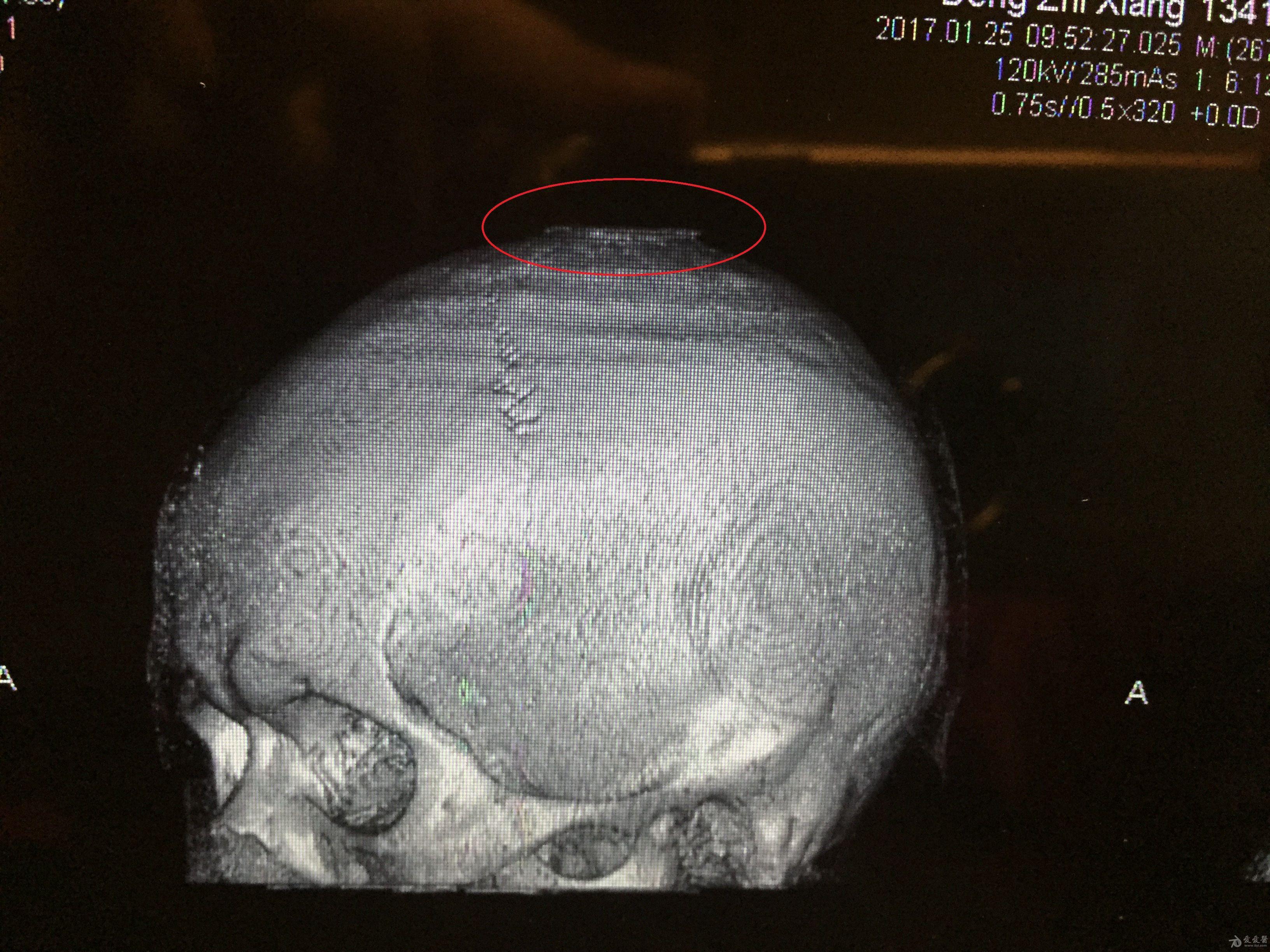 头顶老是刺痛怀疑颅骨有点增生水平方向的是骨刺吗睡觉老是痛