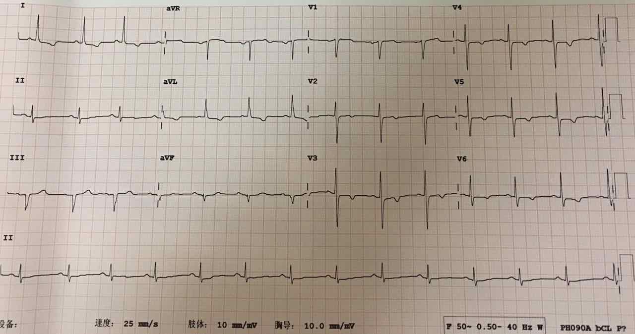 心电图分析 异常q波?