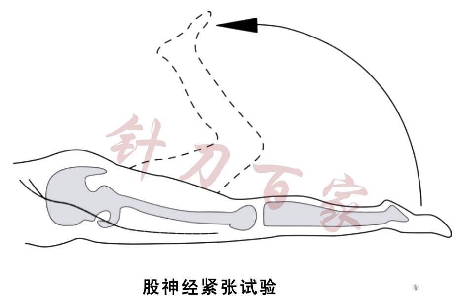 此试验阳性说明l3或l4神经根受到牵拉而紧张,其疼痛是突出的