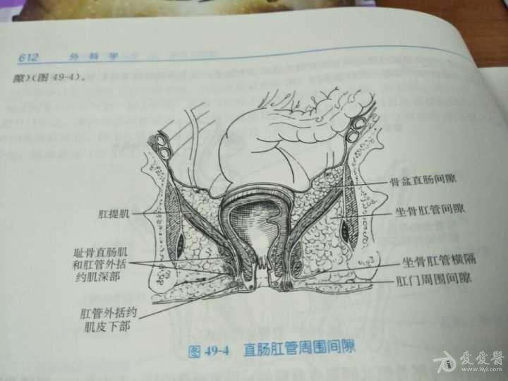 坐骨直肠窝扩展机制在高位复杂肛瘘中的应用