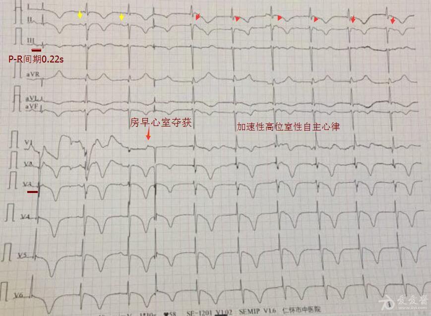 目前的心电图宽阔或很深的冠状t波不好排除心脏本身与脑血管病两种