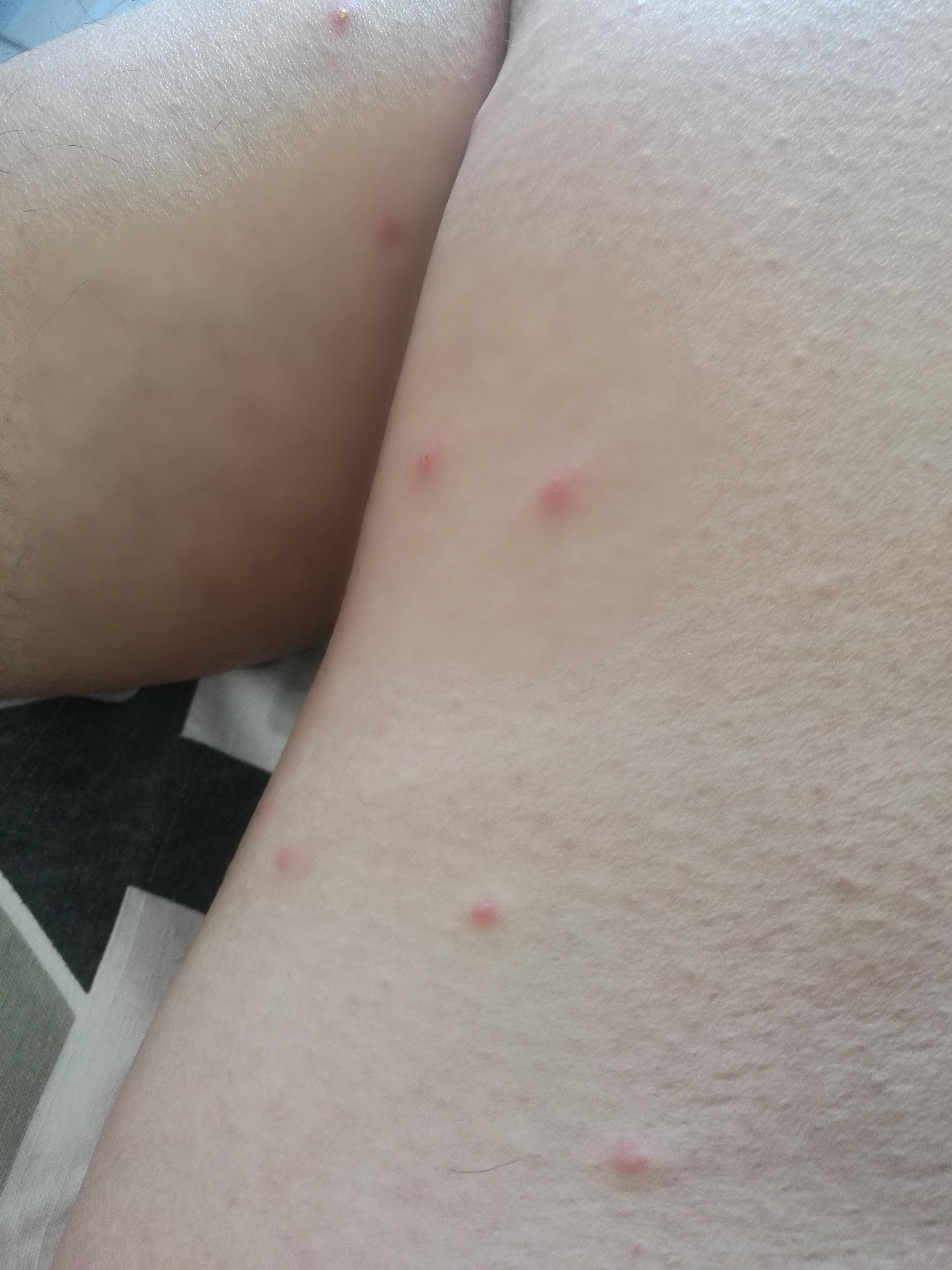 腿上的红色小丘疹是什么?