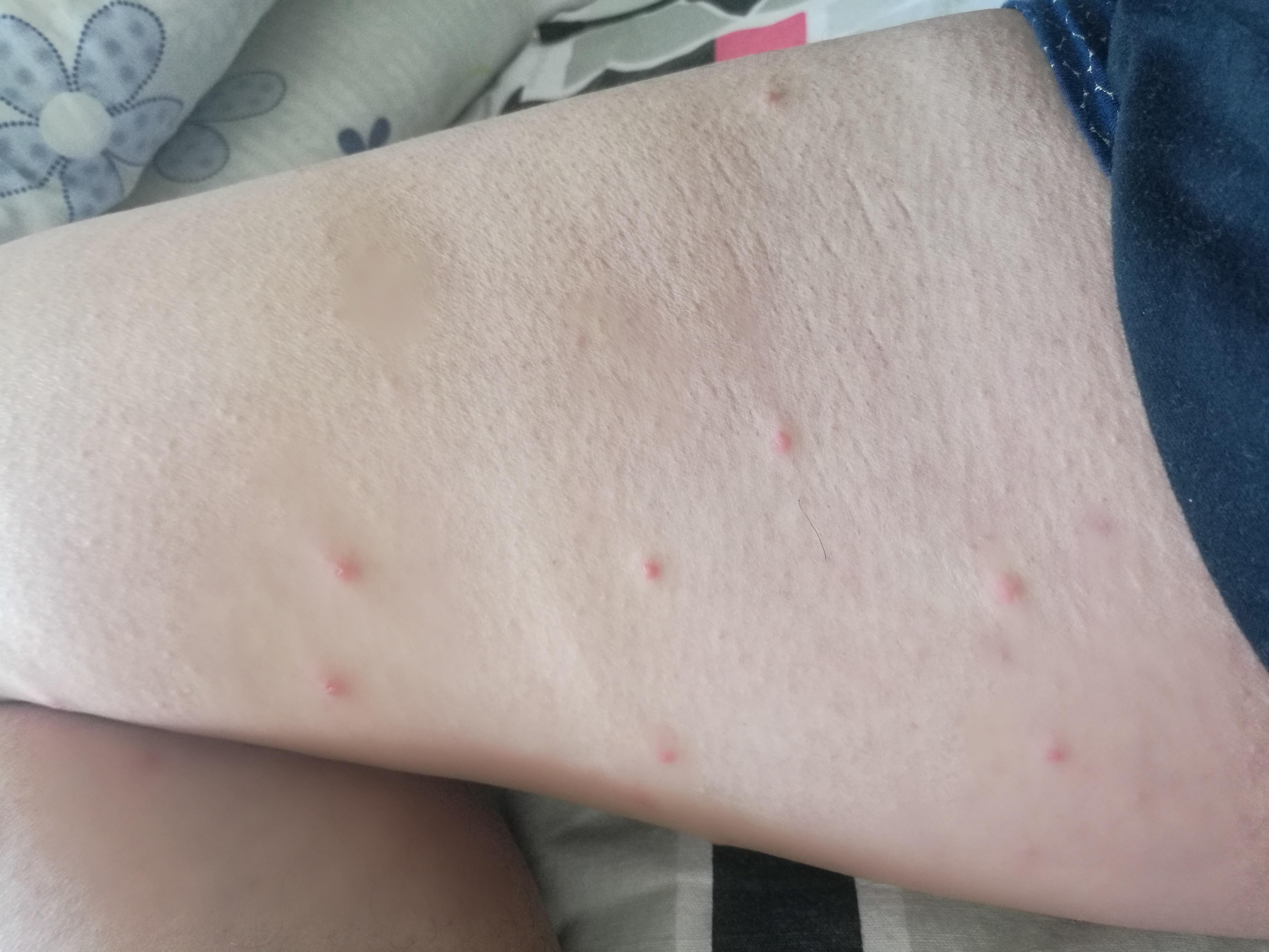 腿上的红色小丘疹是什么