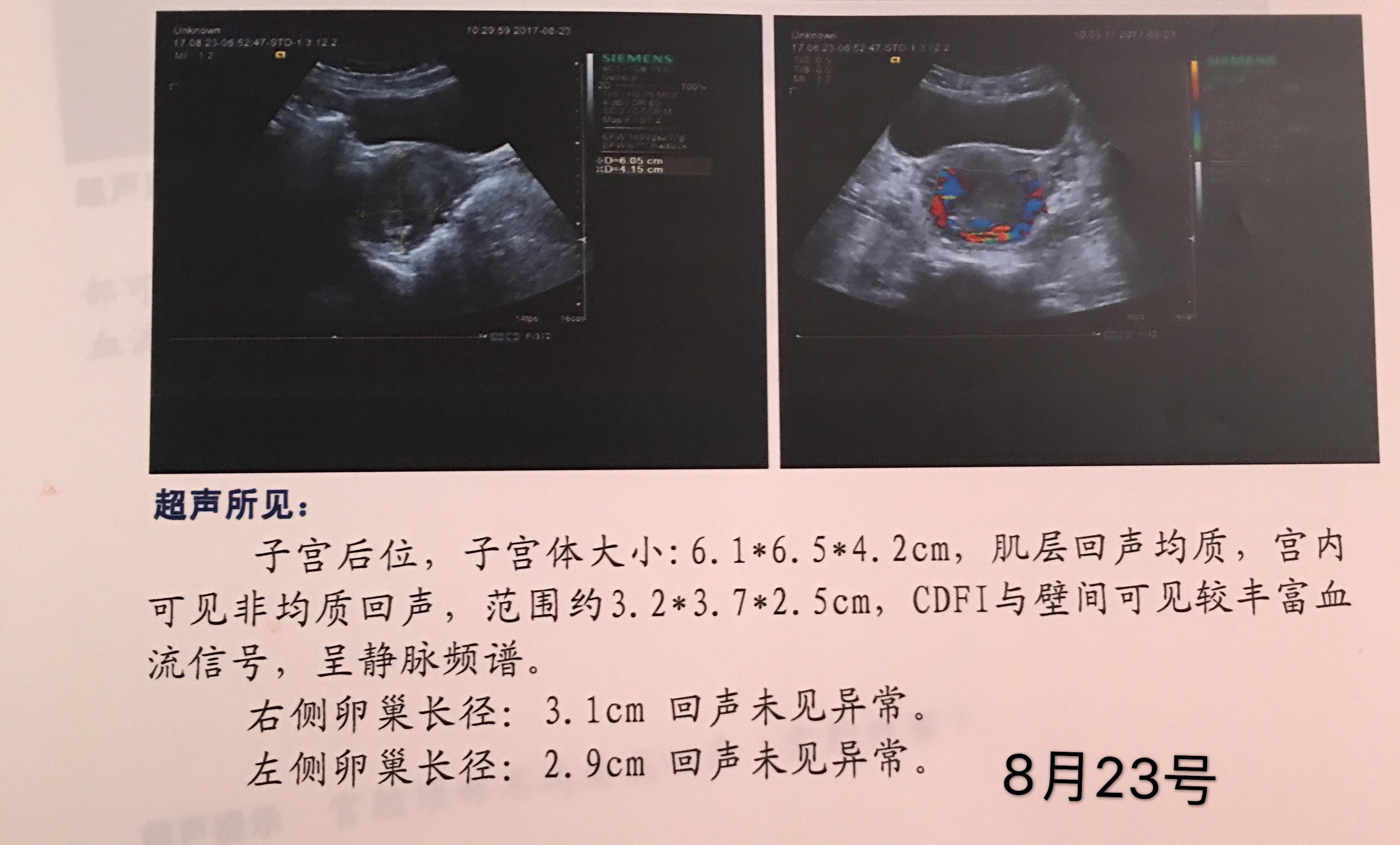 宫腔残留还是动静脉瘘 - 超声医学讨论版 - 爱爱医