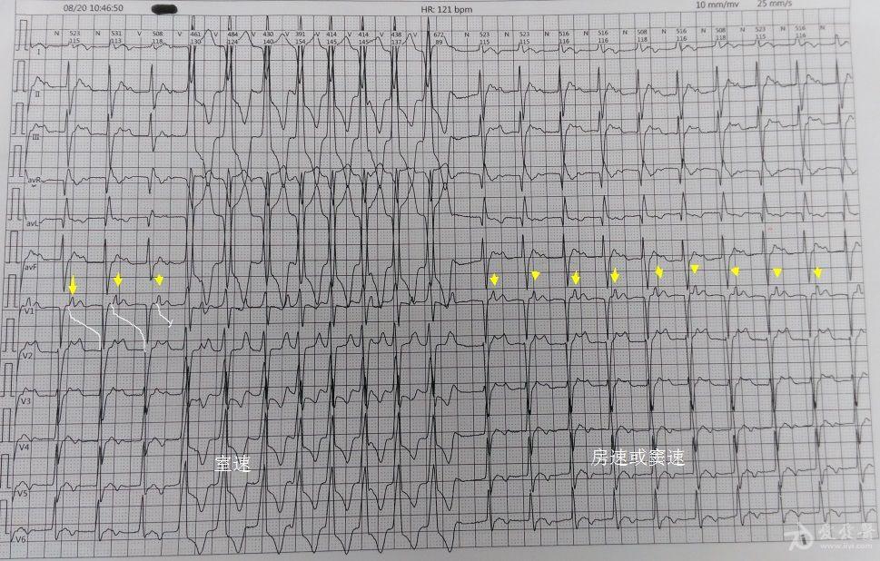 心电图,房速,短阵室速