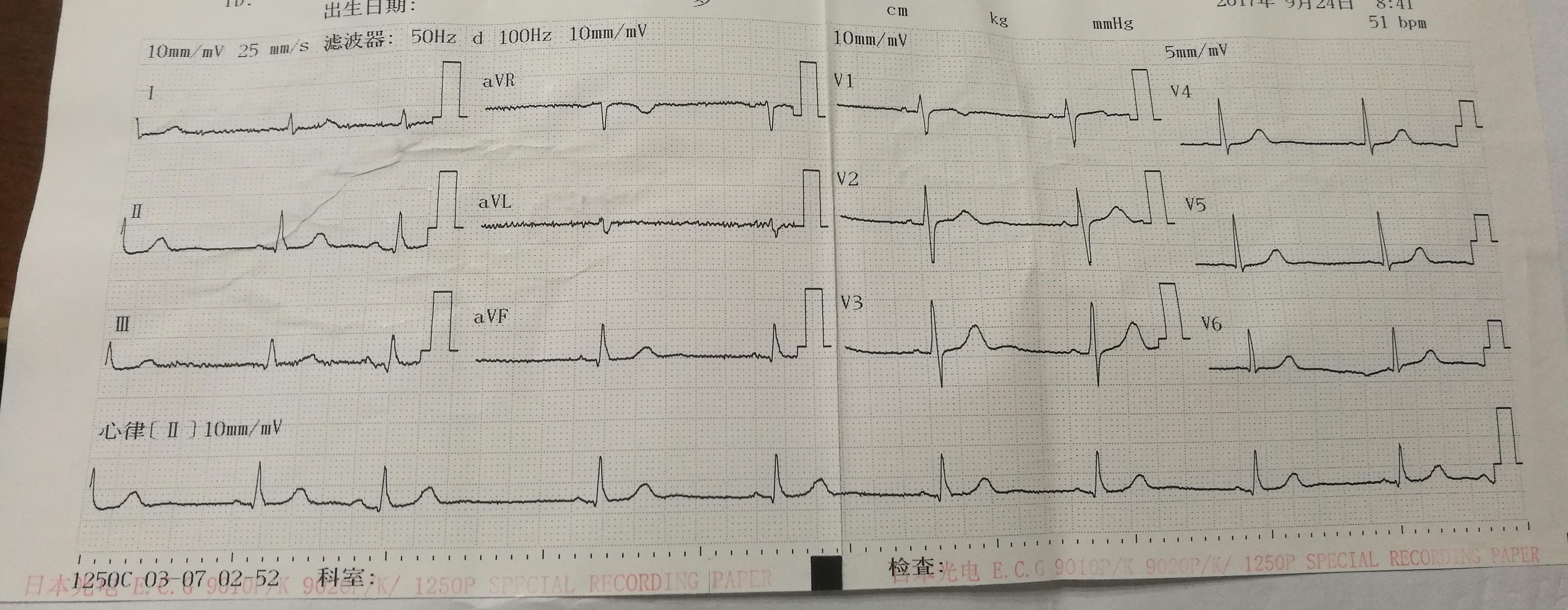 请问这是房性早搏吗?