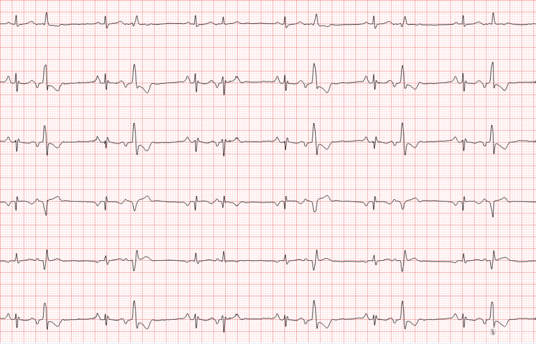 [心电图分析 冬秋-心电图讨论20171028-二联律