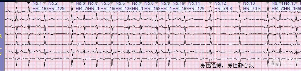 房性心律失常