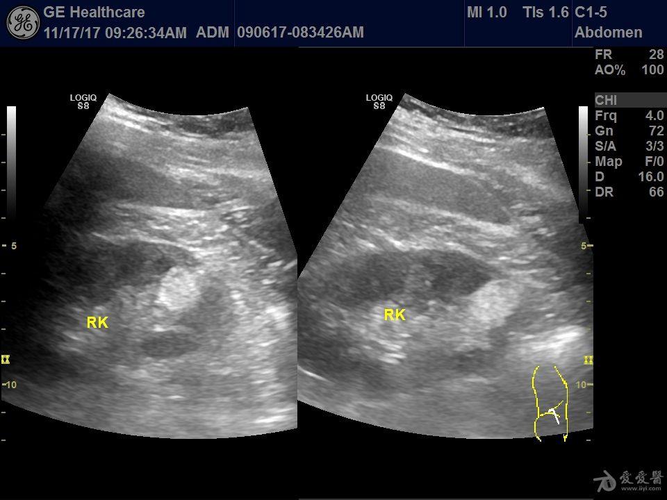 肾错构瘤 - 超声医学讨论版 - 爱爱医医学论坛