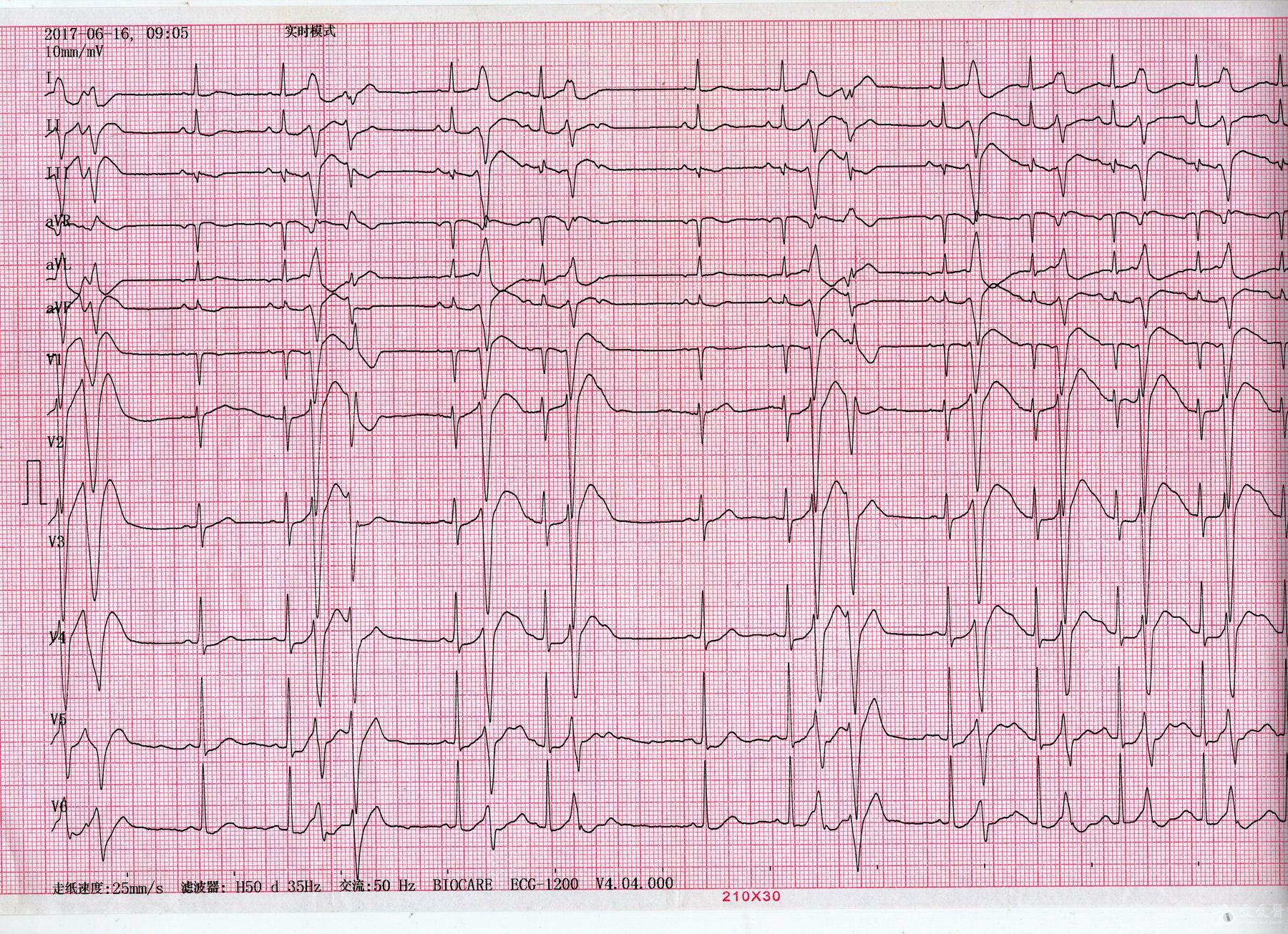 心电图学习20180308