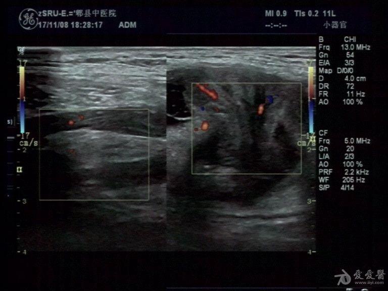 一例典型腹股沟区嵌顿疝 - 超声医学讨论版 - 爱爱医