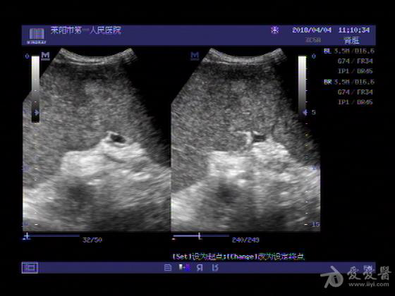 超声入门贴755脾肿瘤并脾大腹腔积液