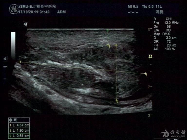 急性附睾炎 - 超声医学讨论版 - 爱爱医医学论坛