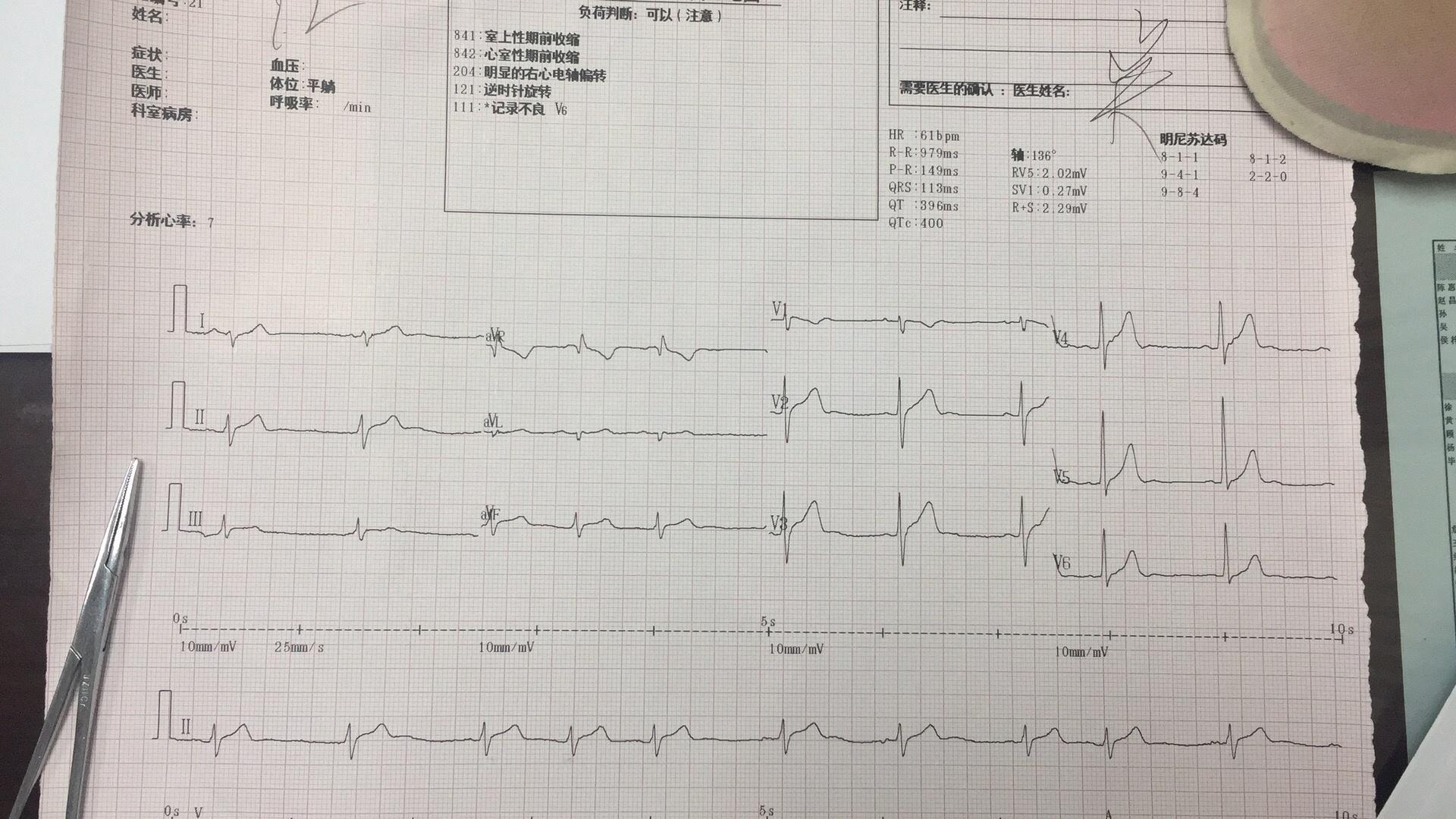 这幅图心电图大家怎么看?
