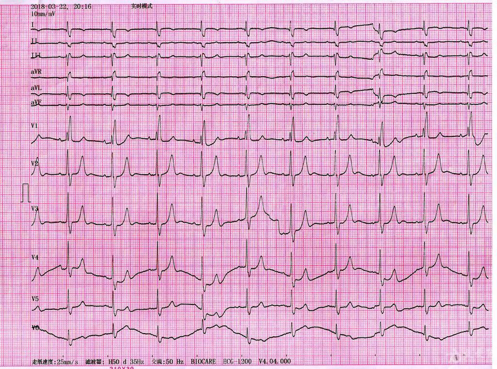 心电图学习201810419