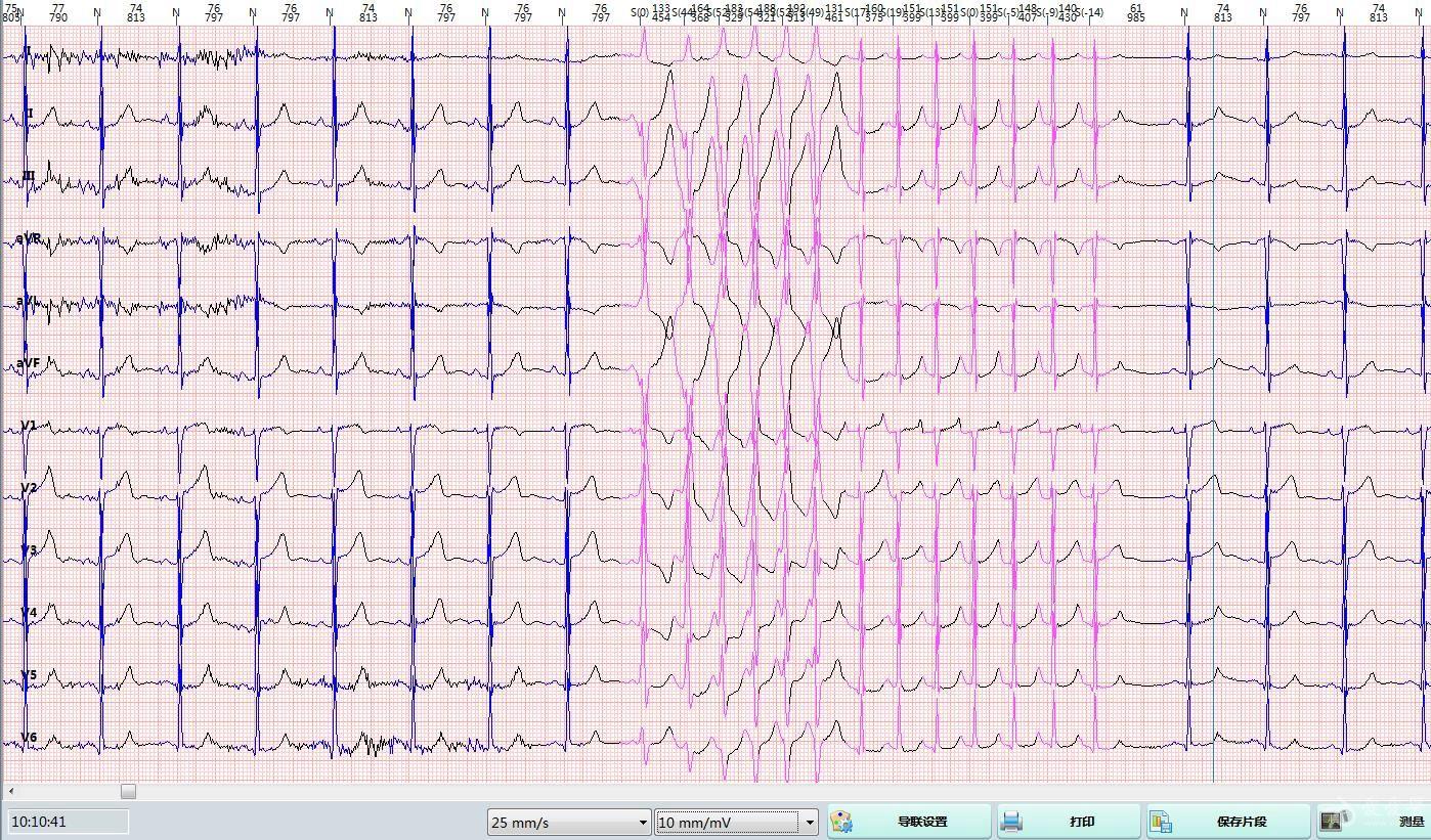 间歇性预激?短阵室速? - 心电图脑电图专业讨论版 - 爱爱医医学论坛