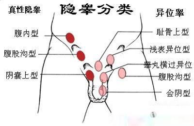 超声入门贴788---隐睾症(腹内型)