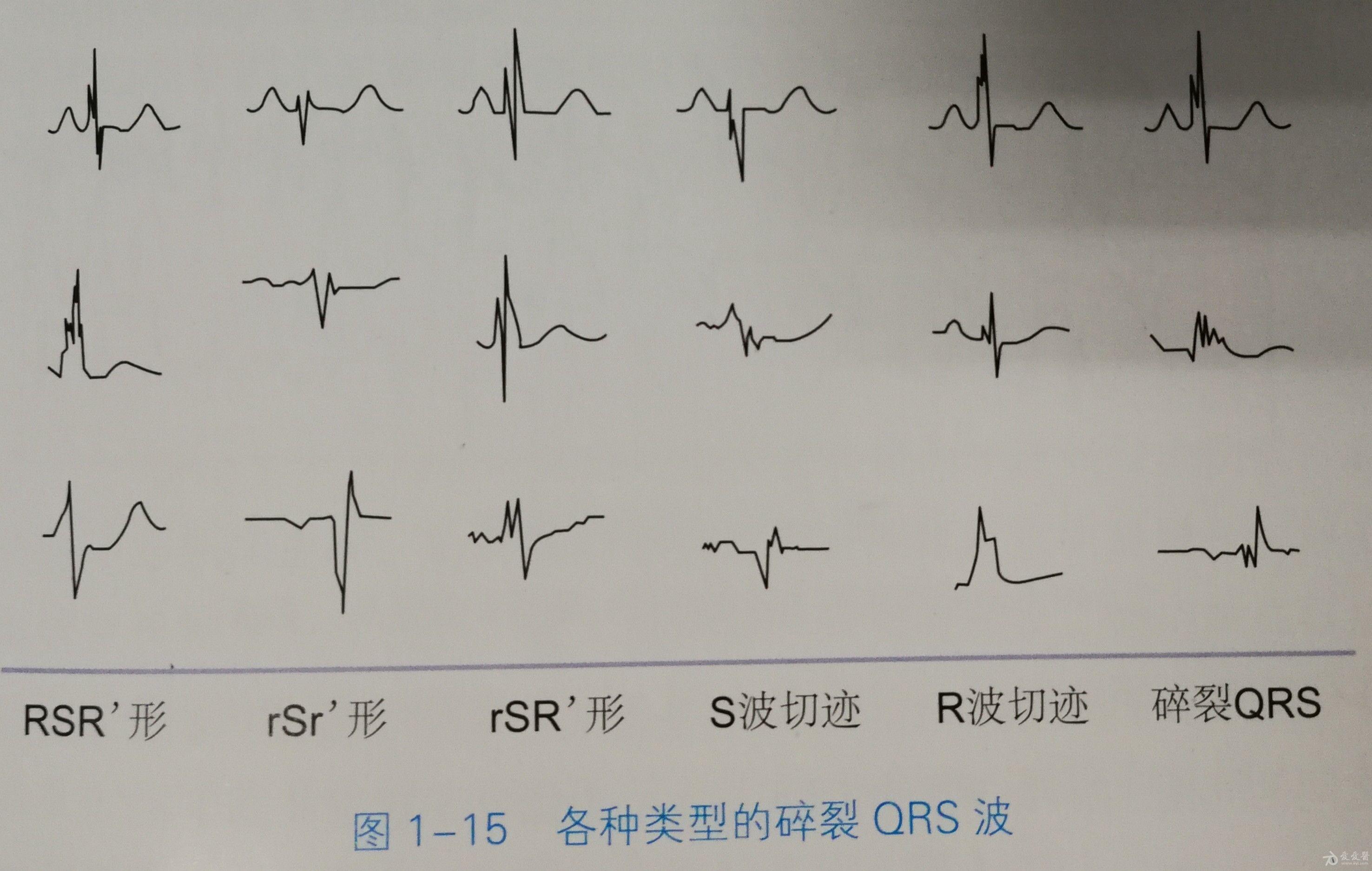 这是碎裂q波吗谢谢