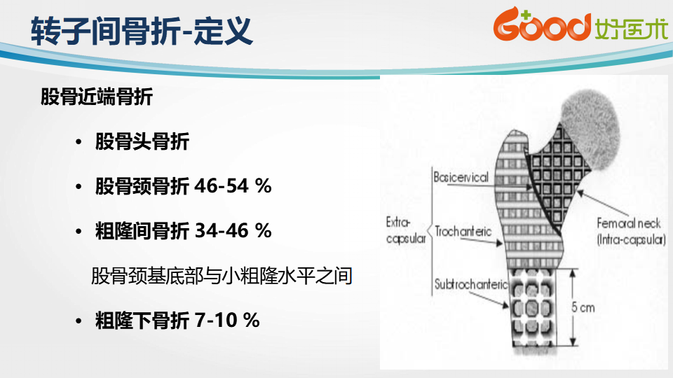 转帖股骨转子间骨折的治疗方法及手术技巧